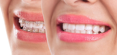 Douglas F. Geiger, DMD, PLLC | Oral Exams, 3D Printing and ClearCorrect reg 