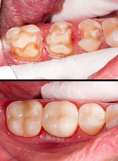 Douglas F. Geiger, DMD, PLLC | Dental Bridges, Crowns and Emergency Treatment