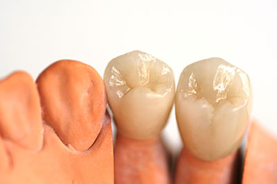 Douglas F. Geiger, DMD, PLLC | Dental Sealants, Emergency Treatment and Preventative Program