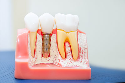 Douglas F. Geiger, DMD, PLLC | Teeth Whitening, Inlays  amp  Onlays and Cosmetic Dentistry