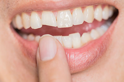 Douglas F. Geiger, DMD, PLLC | Fluoride Treatment, Oral Exams and Oral Cancer Screening