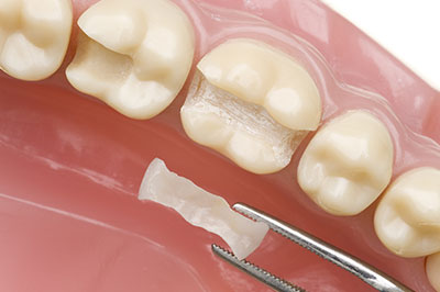 Douglas F. Geiger, DMD, PLLC | Fluoride Treatment, Snoring Appliances and Preventative Program