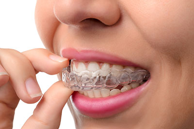 Douglas F. Geiger, DMD, PLLC | Oral Cancer Screening, Sports Mouthguards and Fluoride Treatment