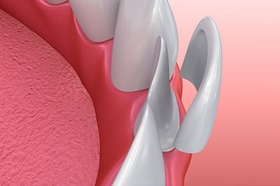 Douglas F. Geiger, DMD, PLLC | Preventative Program, Digital Impressions and 3D Printing